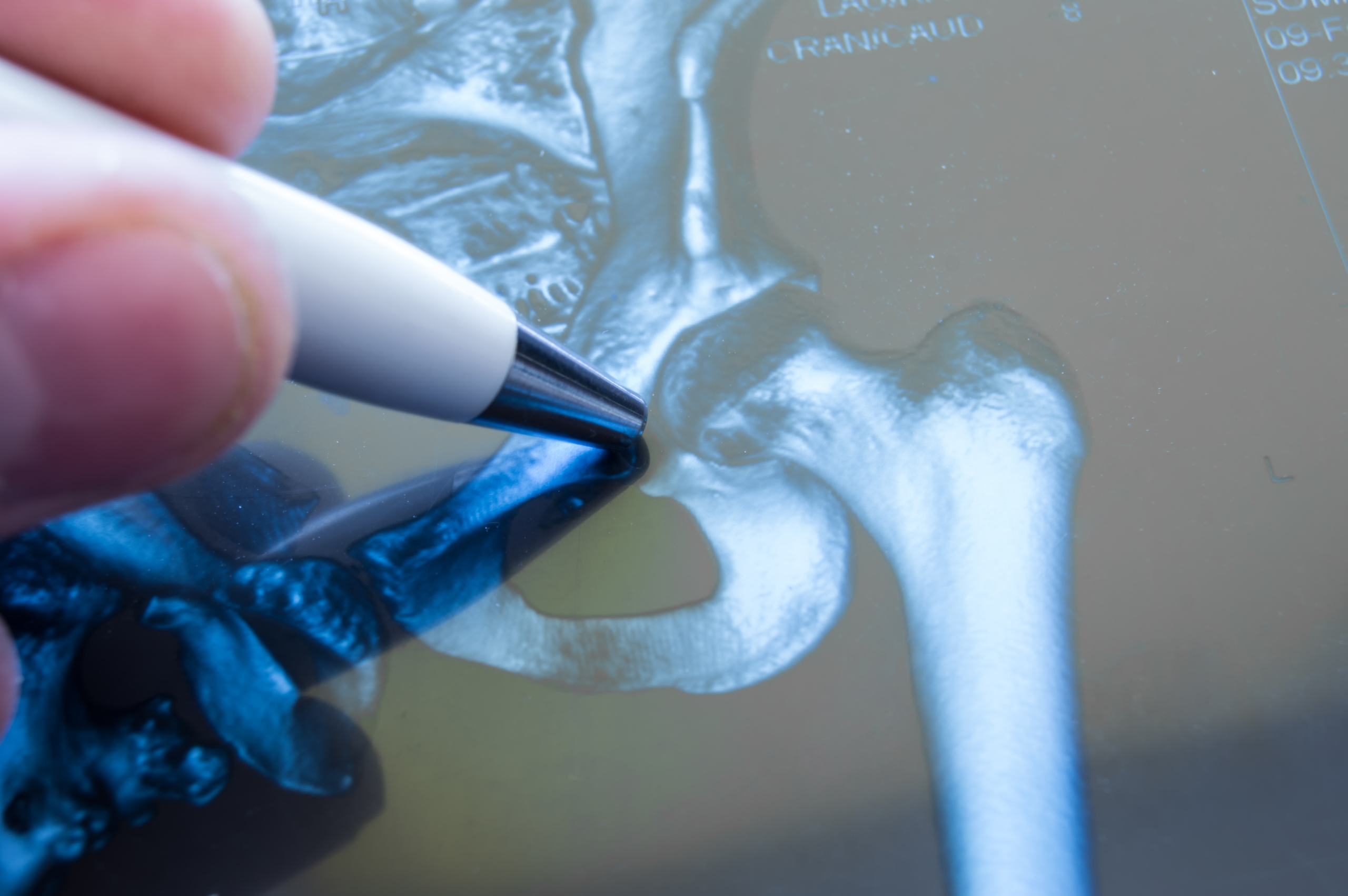 x ray of hip joint