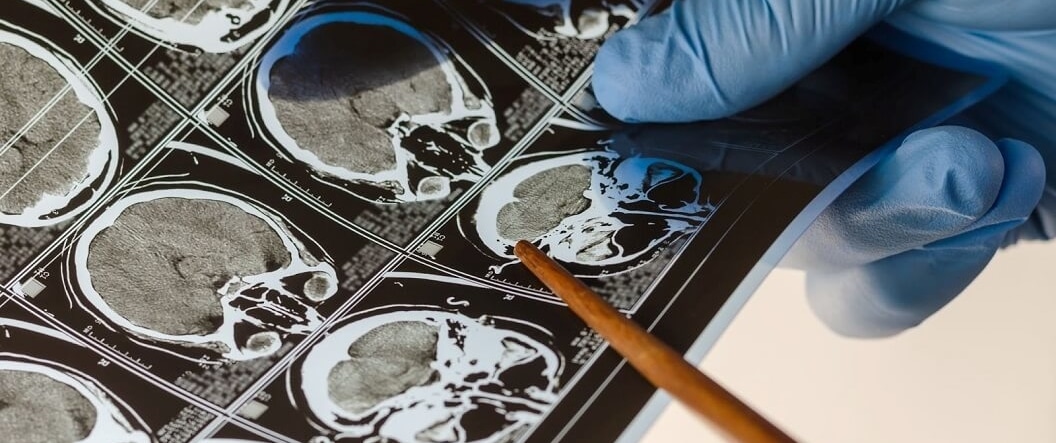 port st lucie brain injury lawyer