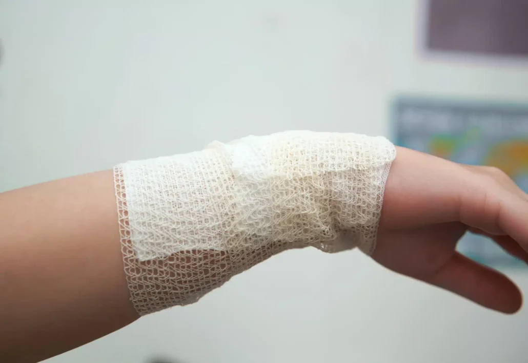 how to treat a burn injury