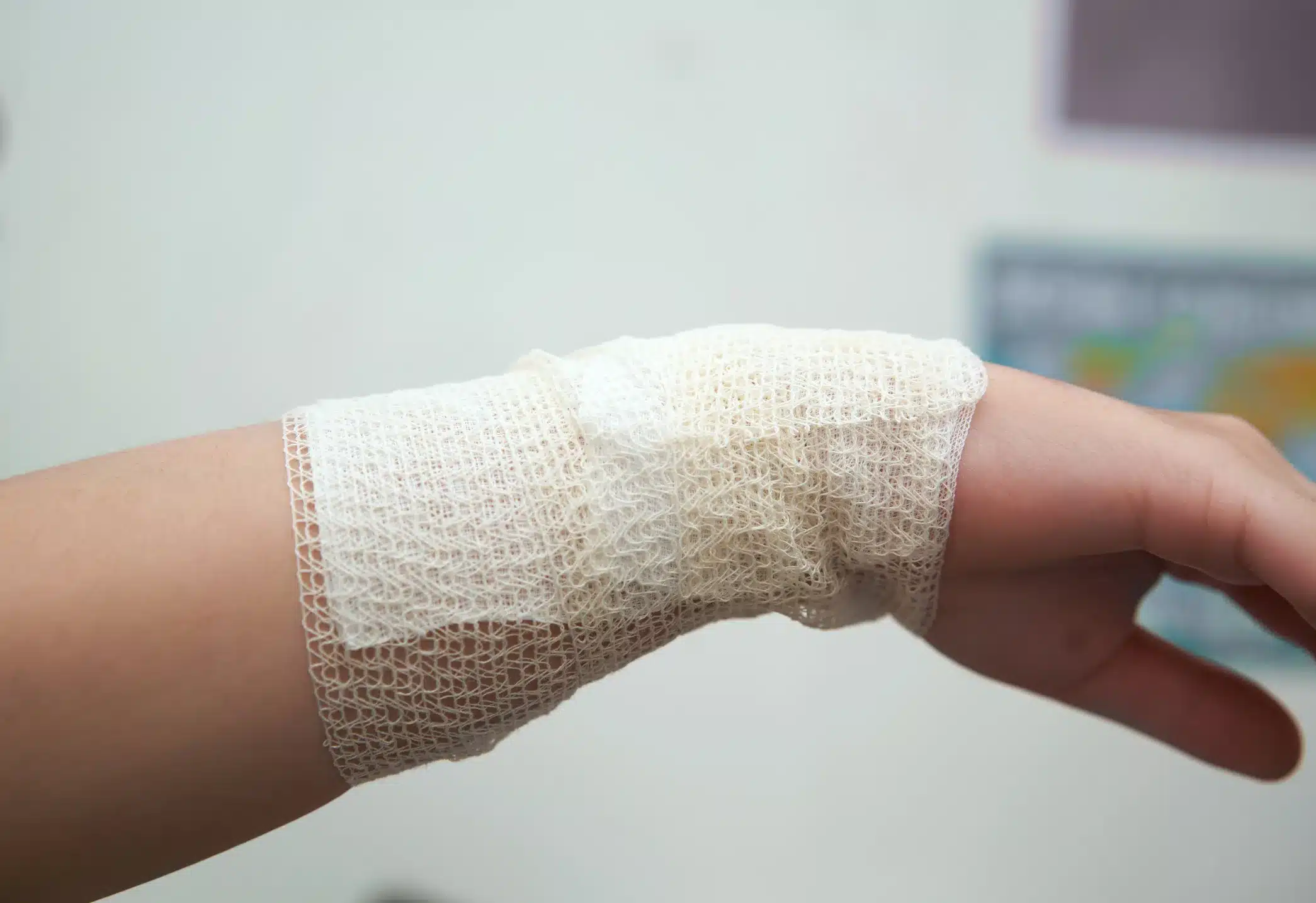 how to treat a burn injury