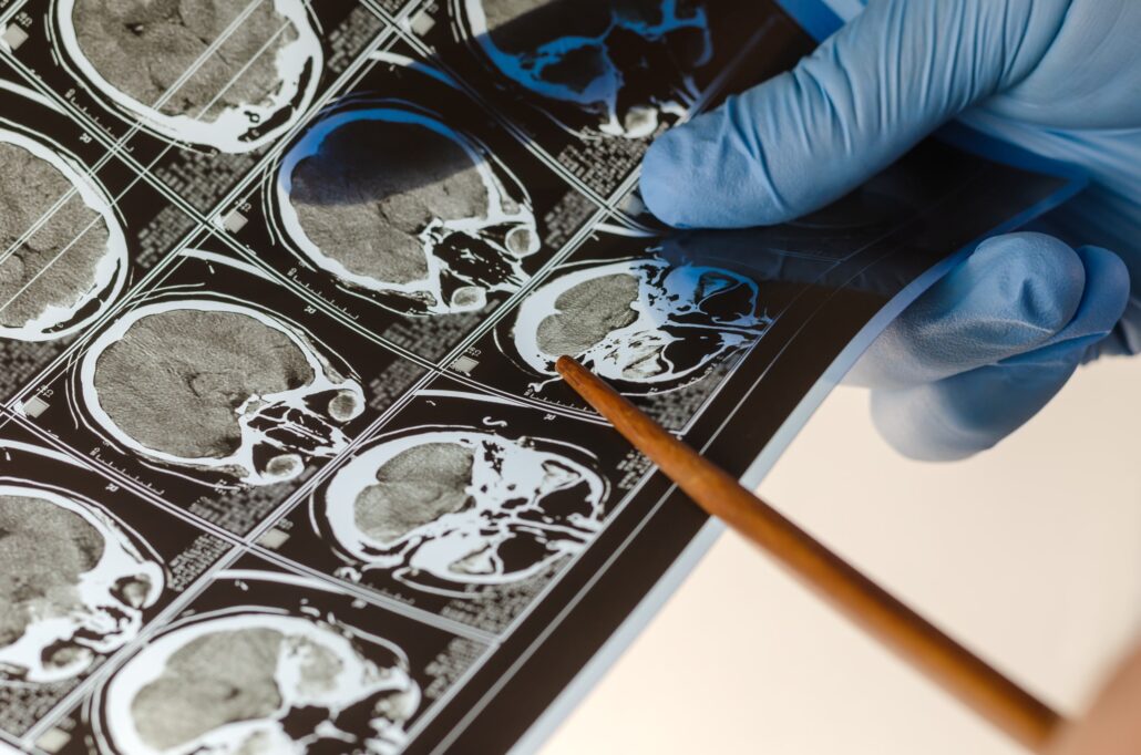 talk and die syndrome